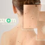 Case study Dermazoom
